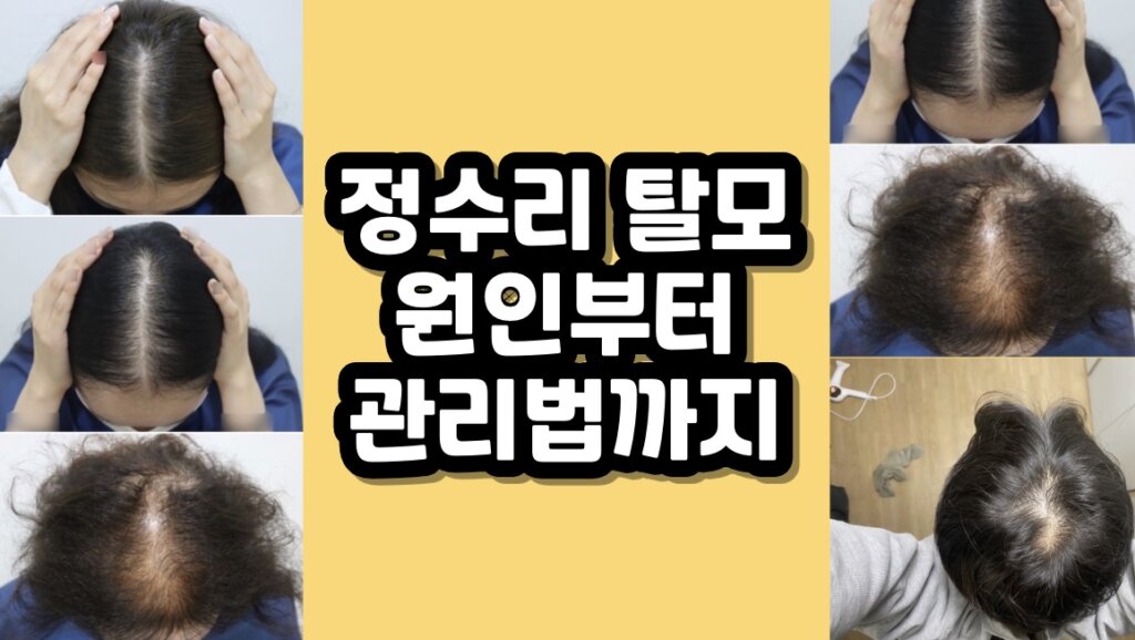 정수리 탈모